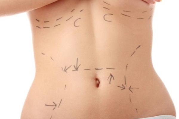 YAĞ ALDIRMA (LIPOSUCTION)
