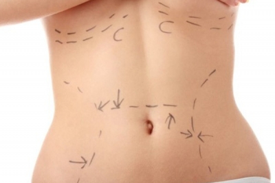 YAĞ ALDIRMA (LIPOSUCTION)