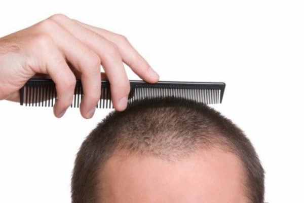 HAIR TRANSPLANT